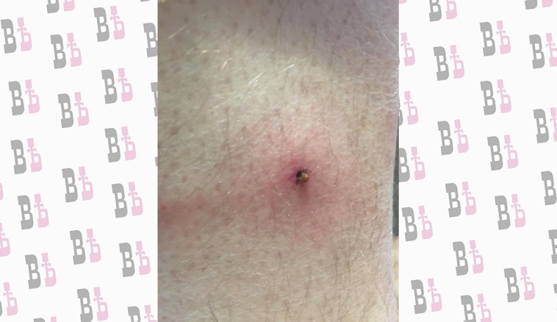 В Калужской области за неделю от укусов клещей пострадали 77 человек