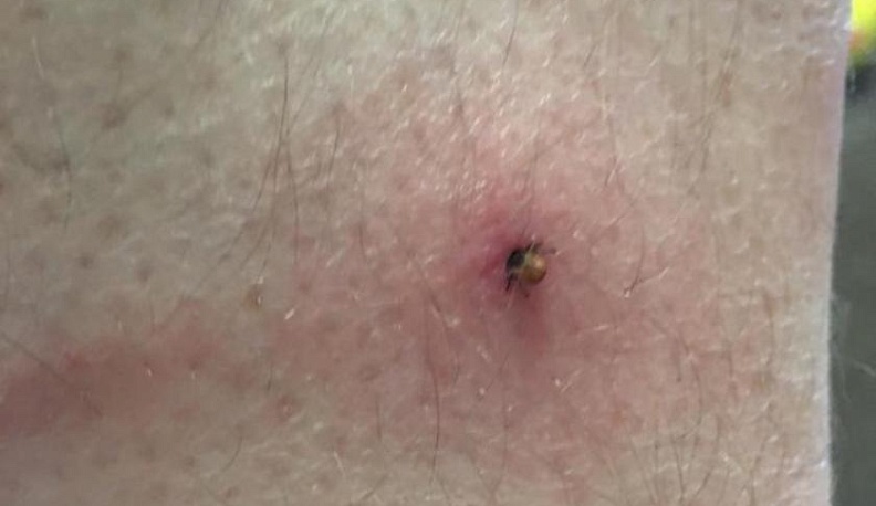 В Калужской области районные больницы будут принимать клещей на исследование 