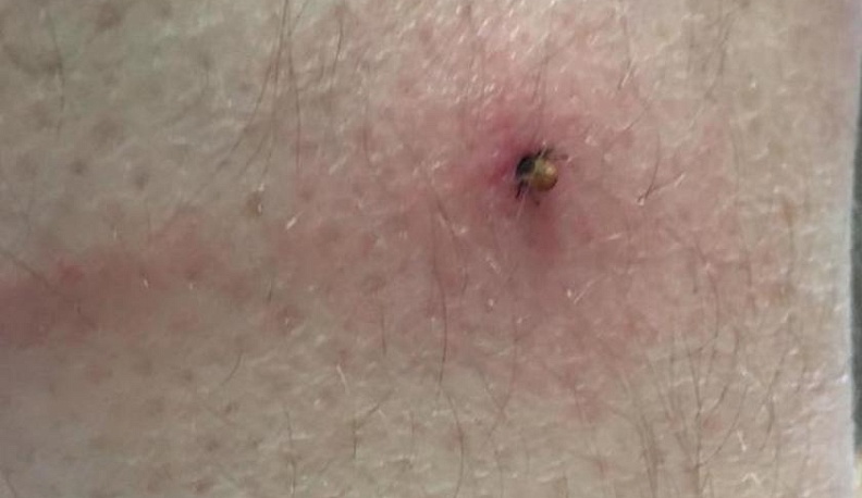 В Калужской области от укусов клещей пострадали 76 взрослых и 19 детей