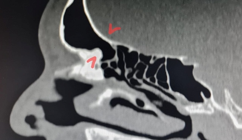В Калужской области успешно провели сложнейшую операцию на лобных пазухах