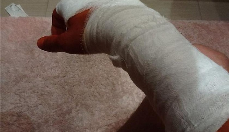 Пьяный грузчик лишился пальцев на калужском заводе