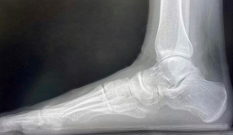 Для 189 калужан Новый год начался с травмпункта