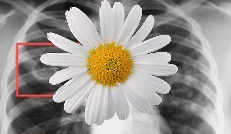 Калужская область борется с туберкулезом успешно